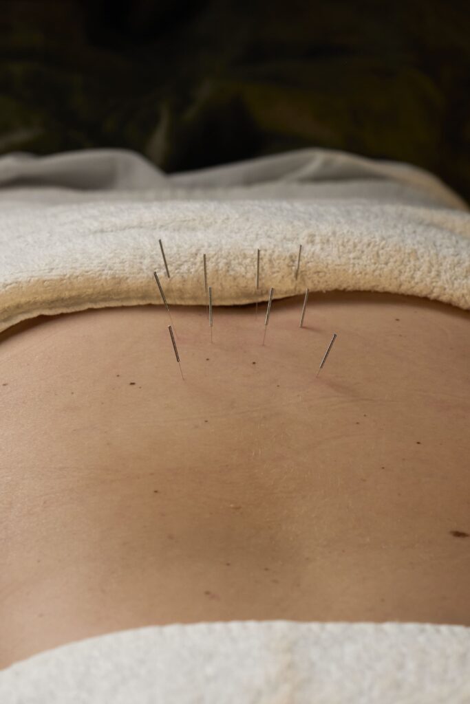 Acupuncture session at Bloor West Retreat in Toronto for stress relief, pain management, and holistic wellness
