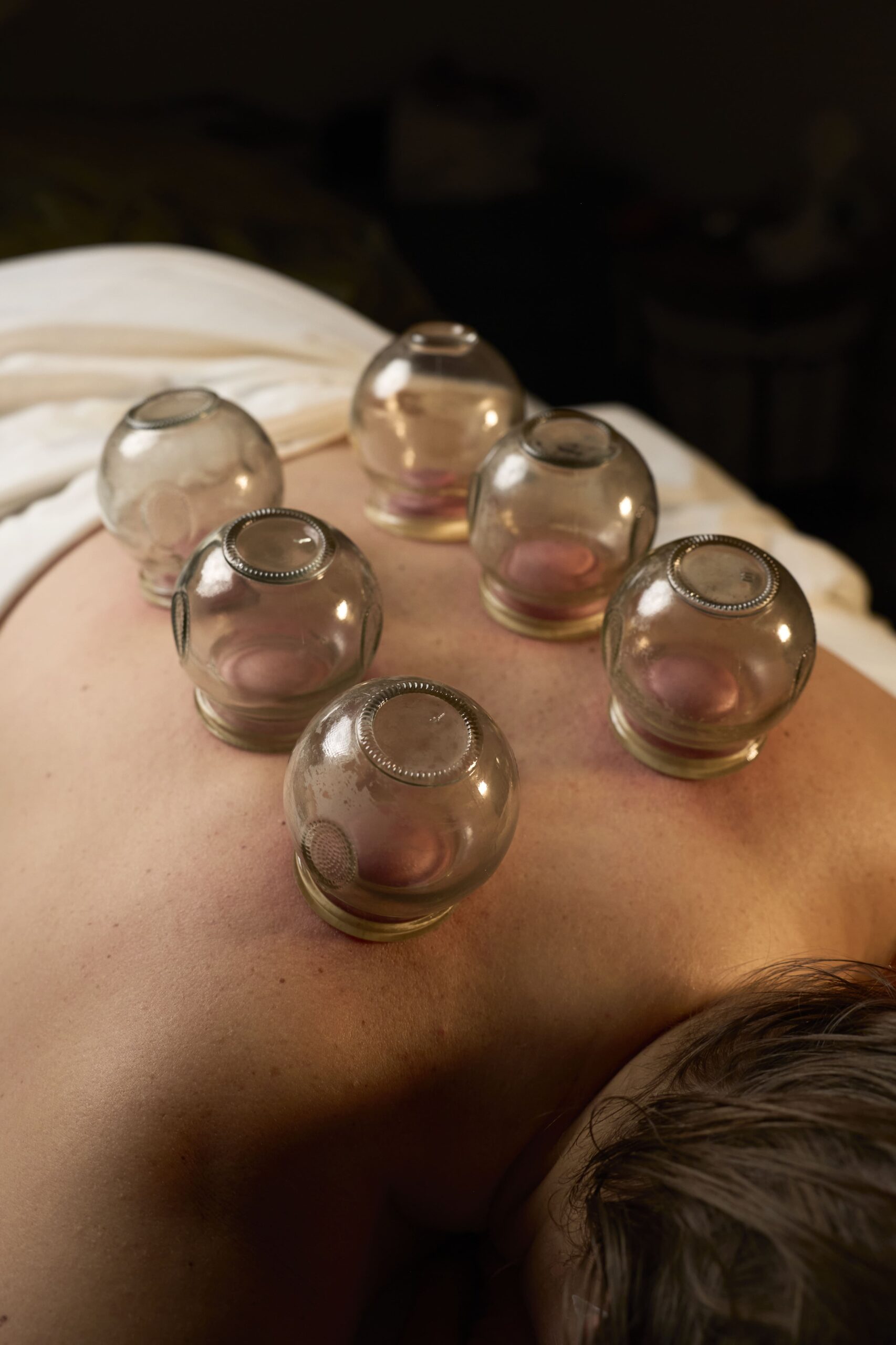Cupping therapy session at Bloor West Retreat in Toronto to relieve muscle tension and improve circulation